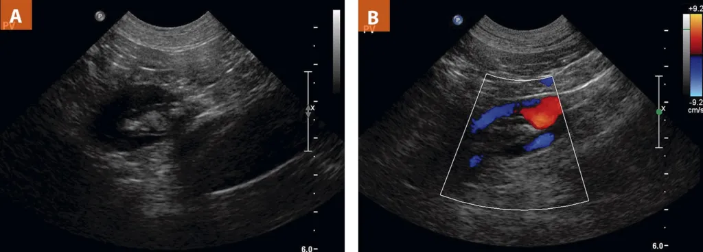 Sonogram without (A) and with (B) color flow doppler